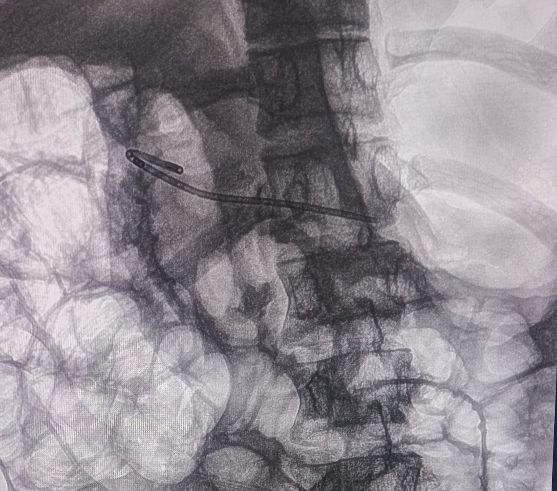 Chronic Pancreatitis ERCP Image 1